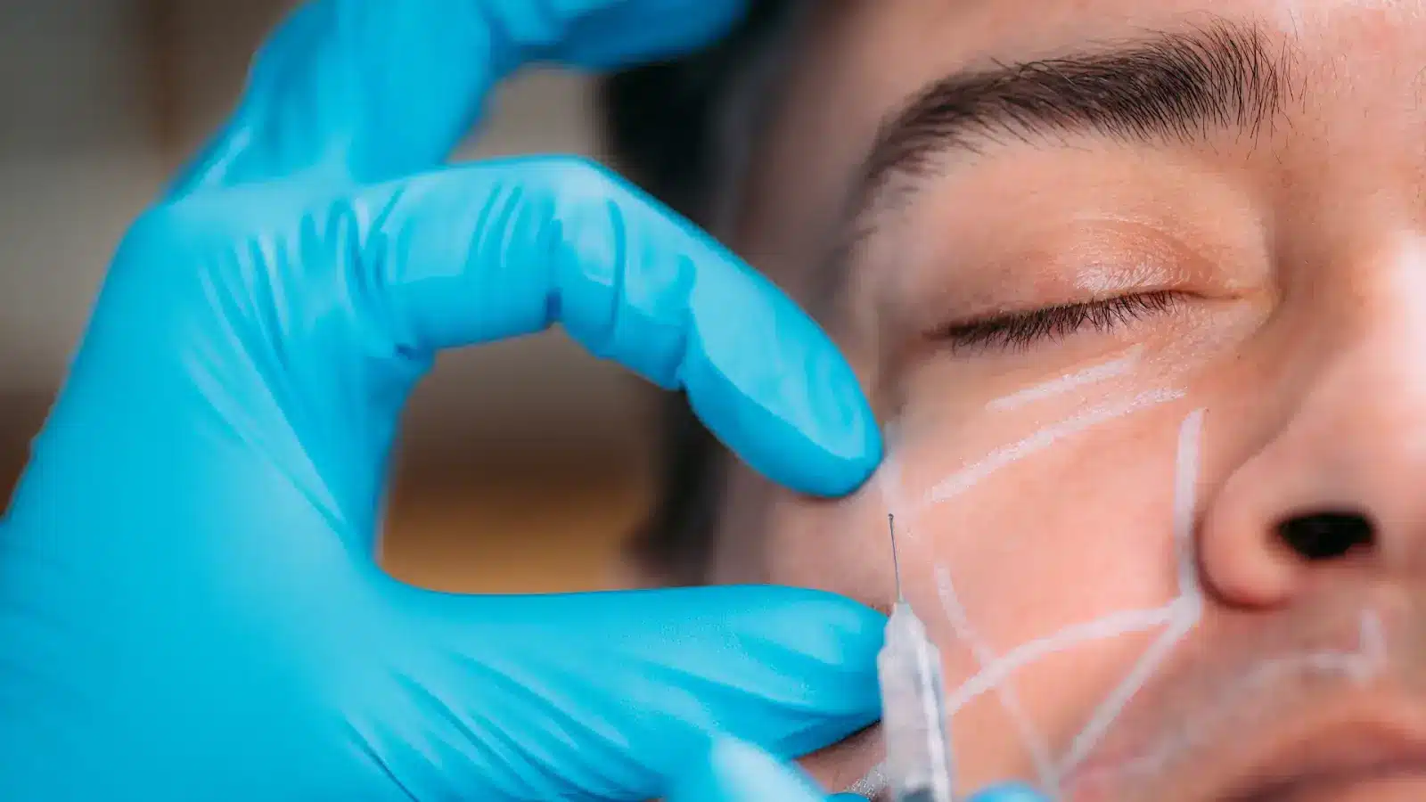 Facial injection. 
