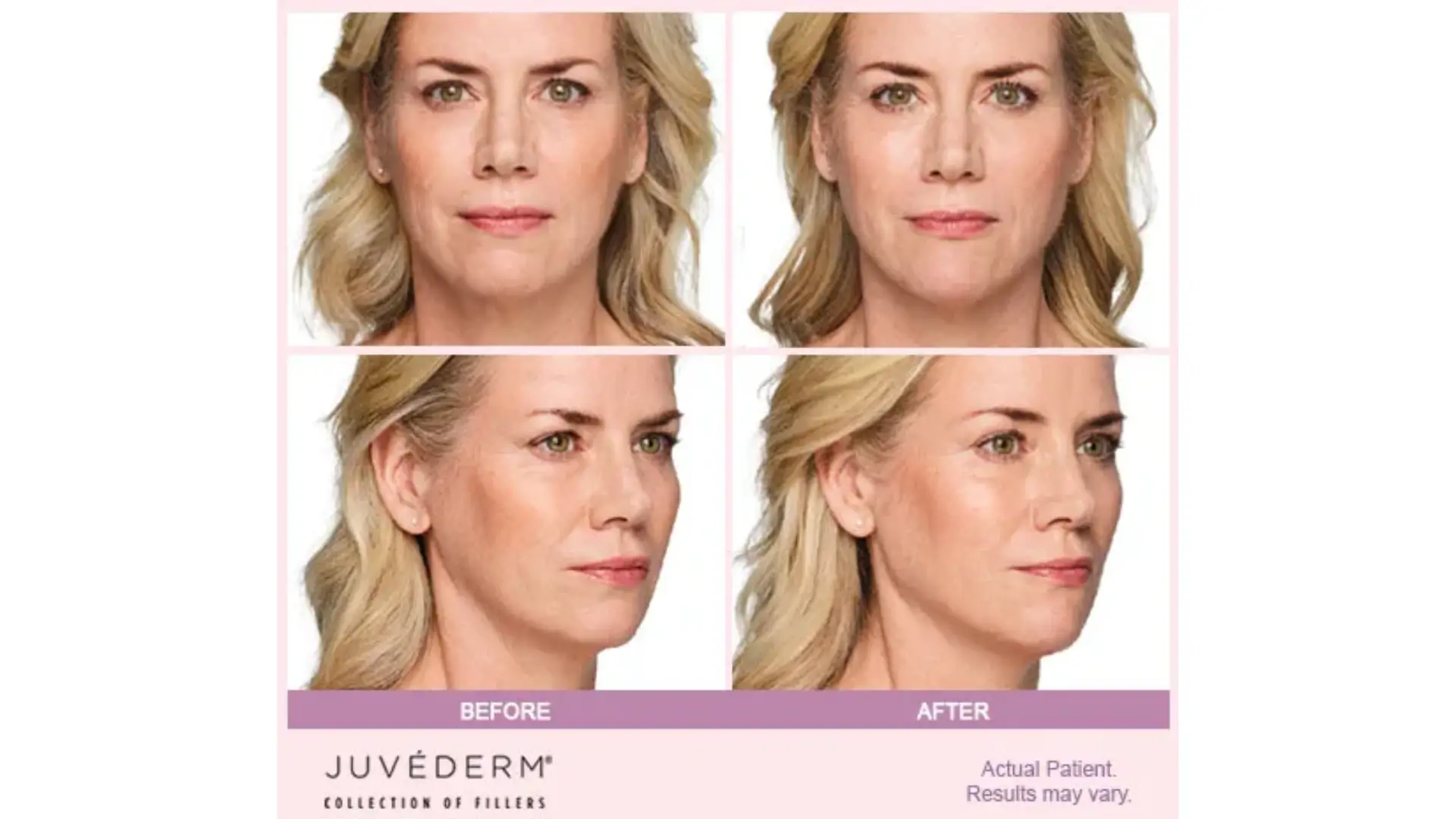 Comparison of Before and After Results for Juvederm