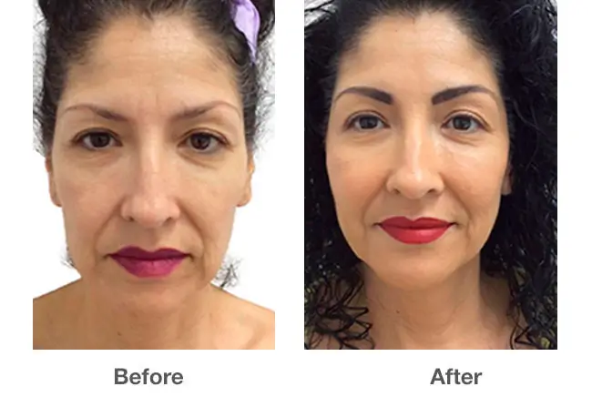 Comparison of Before and After Results for Bellast