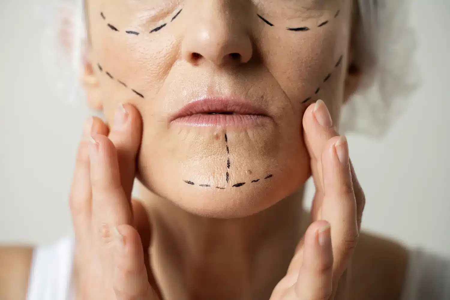 Woman before facial filler treatment, visible markings on the face where the practitioner will inject the filler.