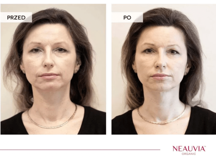 Neauvia Before And After.