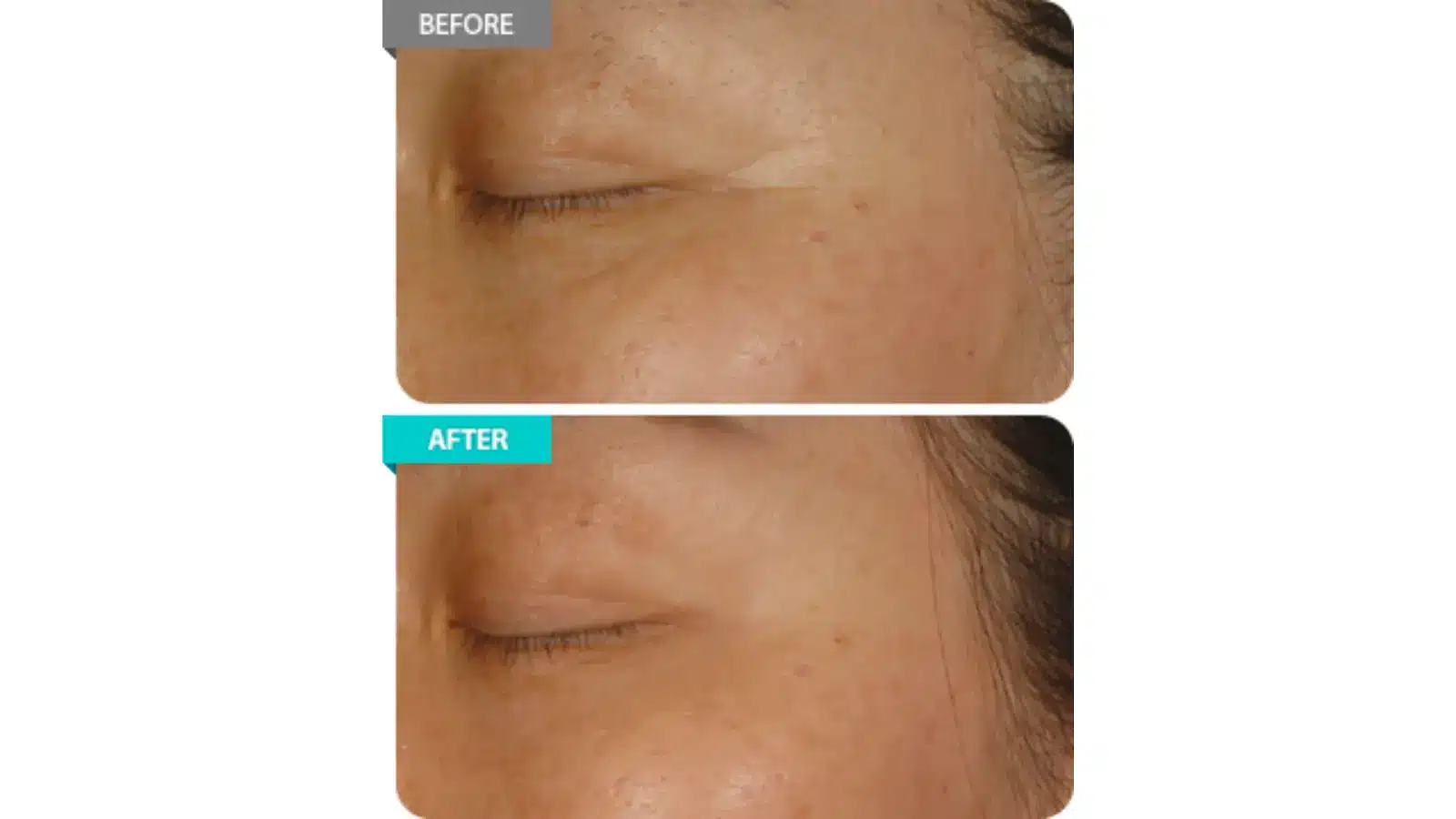Patient Experiences with Revofil Filler 1