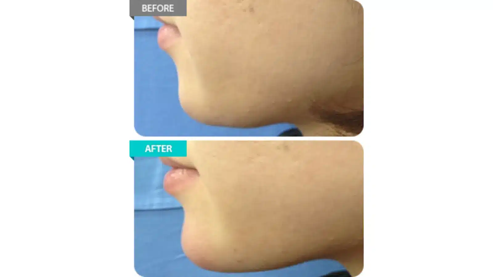 Patient Experiences with Revofil Filler 2