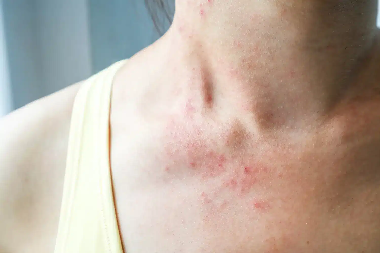 Allergic reactions and itching to the filler treatment.