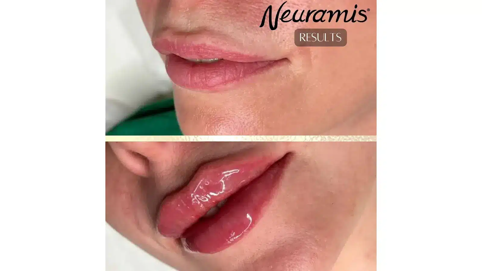 Real results of Neuramis filler
