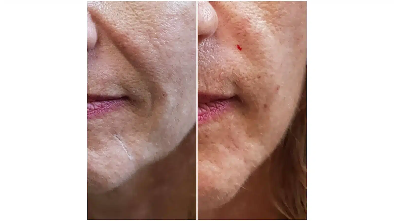 Real results with Neuramis fillers