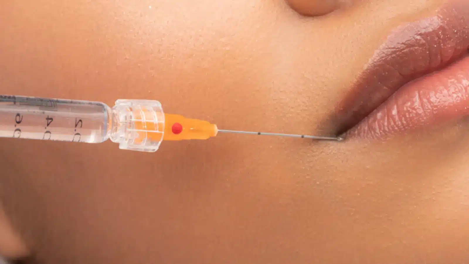 Microcanula injection.