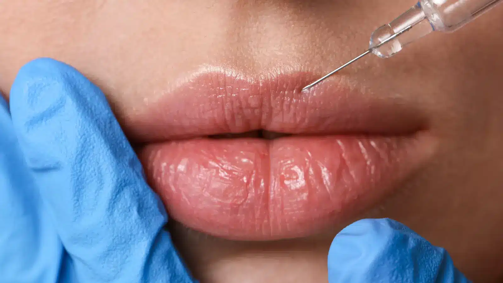 Lip injection.
