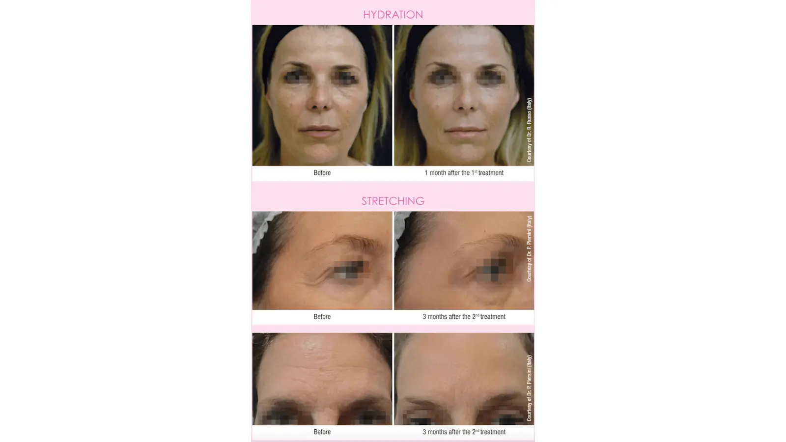 Before and After comparison