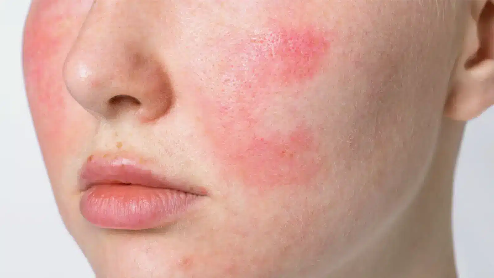 Facial redness.