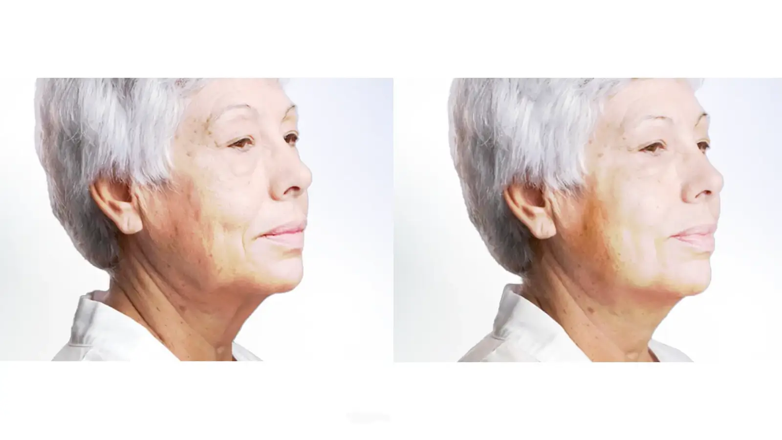 before and after comparison of the thread lift procedure