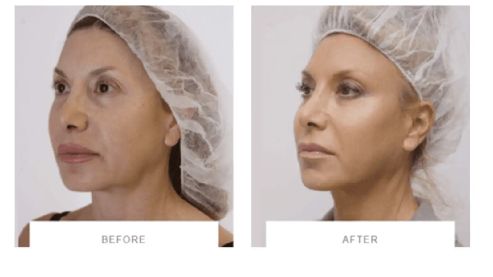 Before and after image of the treatment
