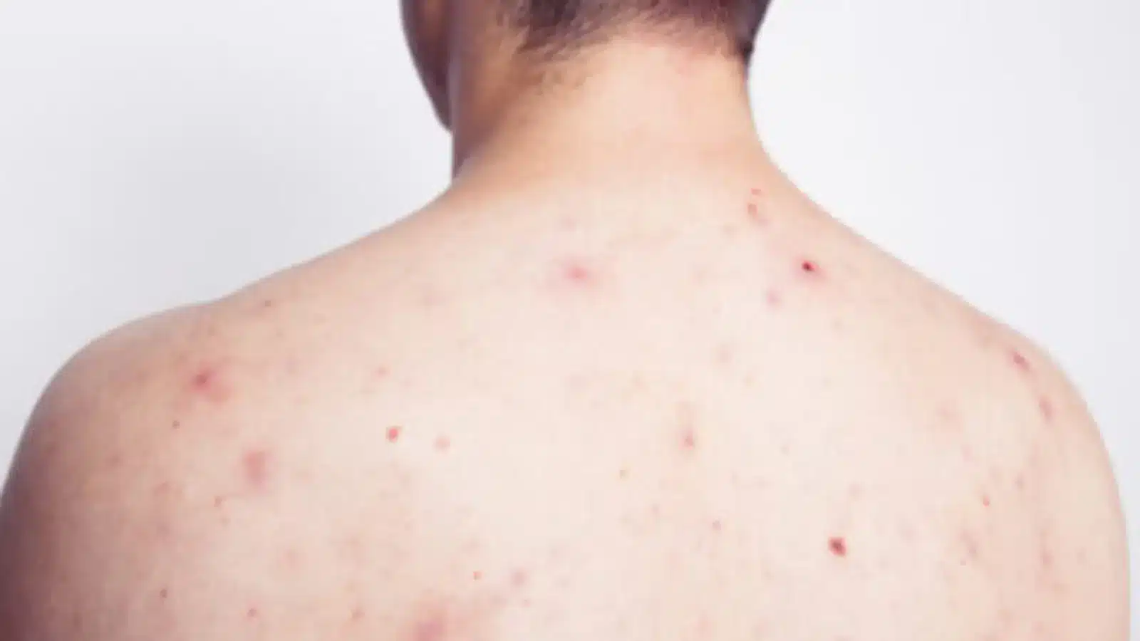 Side Effect Profiles Orencia vs Cimzia