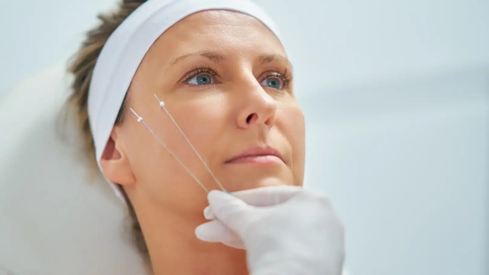 thread lift procedure
