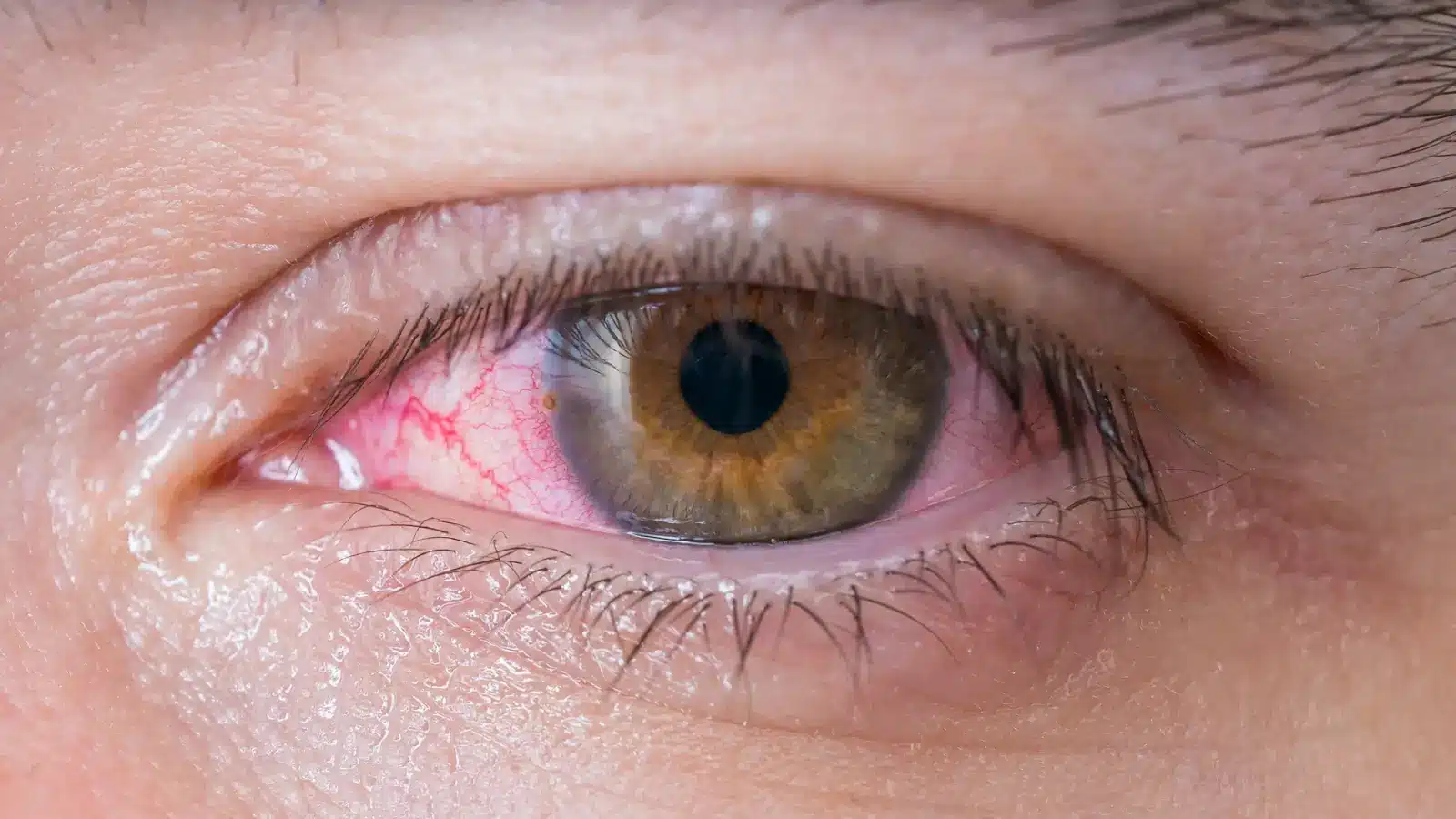 Eye redness.