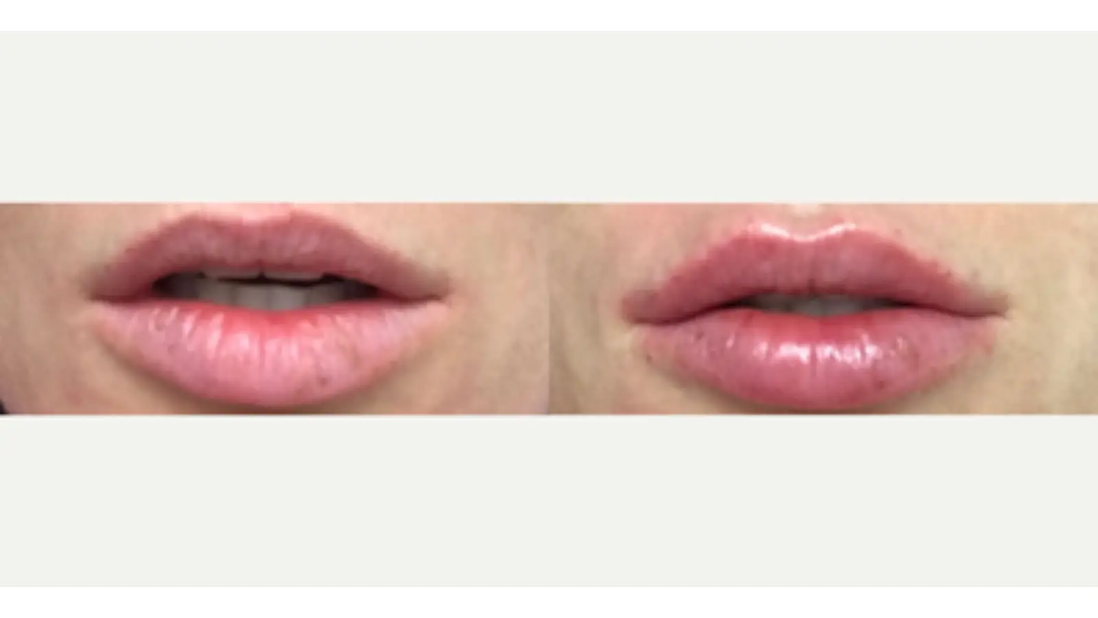 Person with improved lips. 