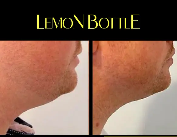 Before and after picture. 