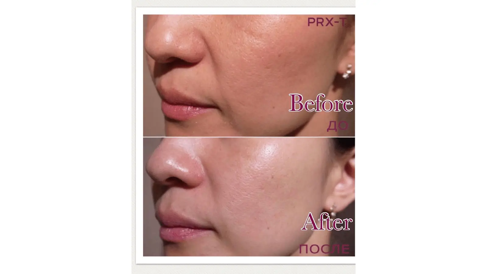 Photo Gallery PRX T33 Results for Acne