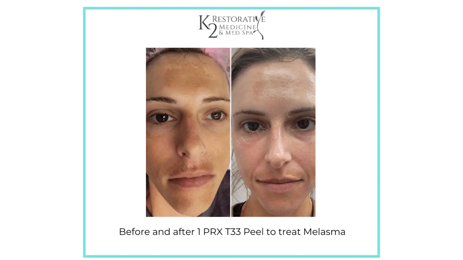 Photo Gallery PRX T33 Results for Pigmentation