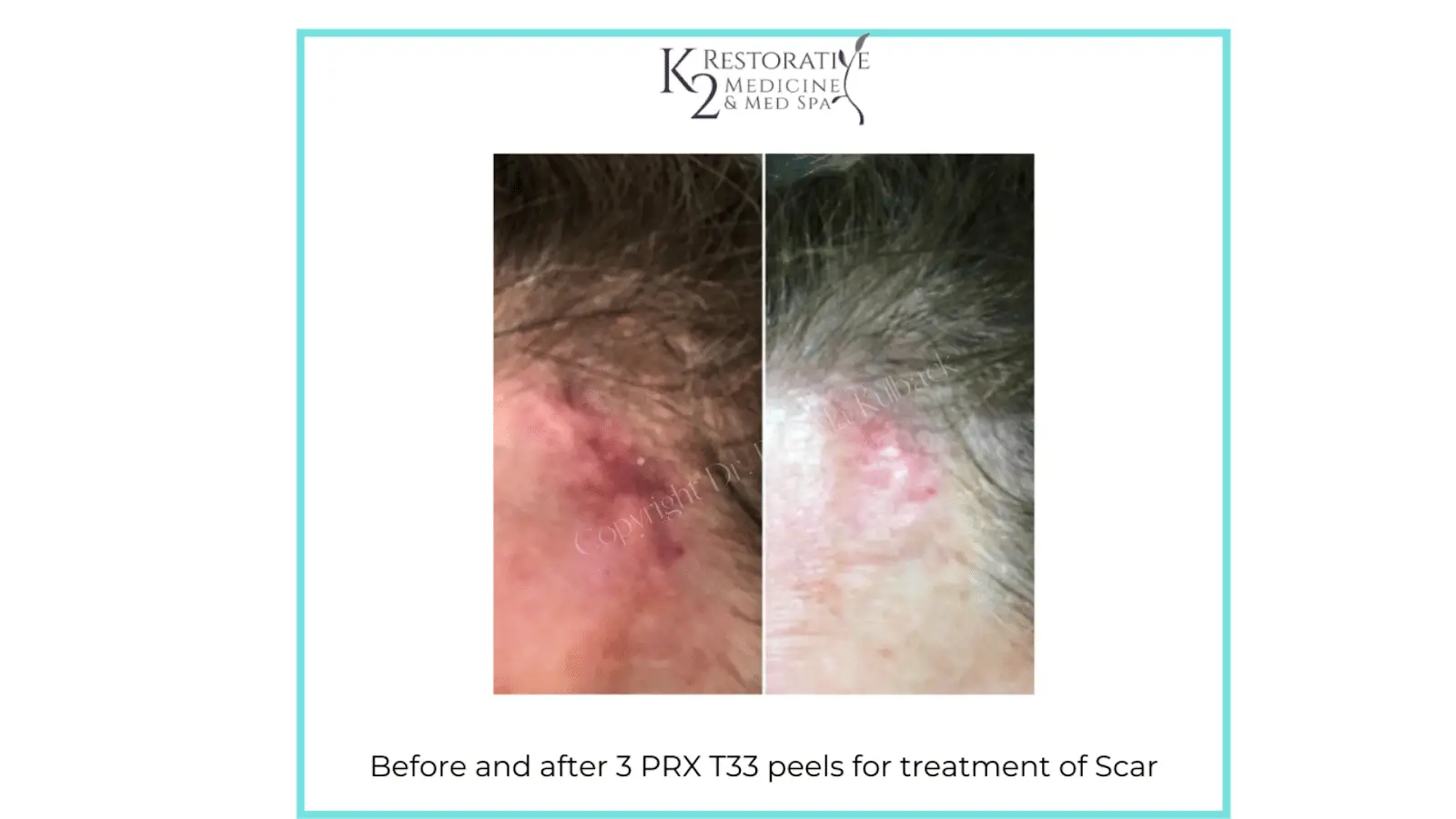 Photo Gallery PRX T33 Results for Acne